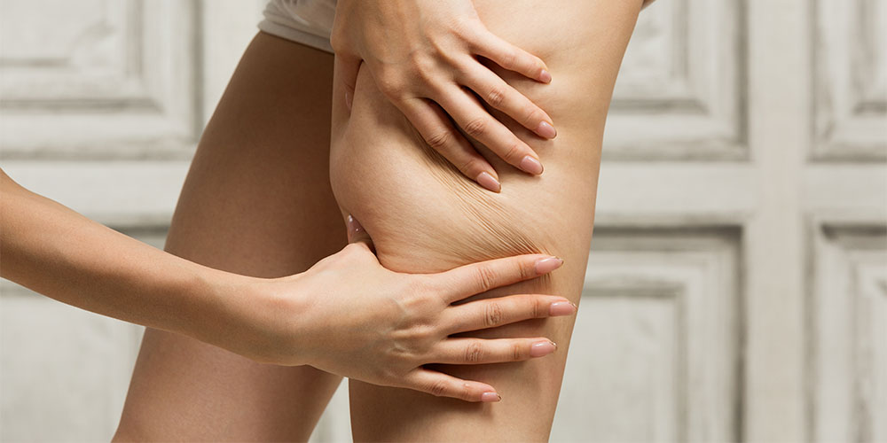 Come eliminare la cellulite: dieta e attività fisica