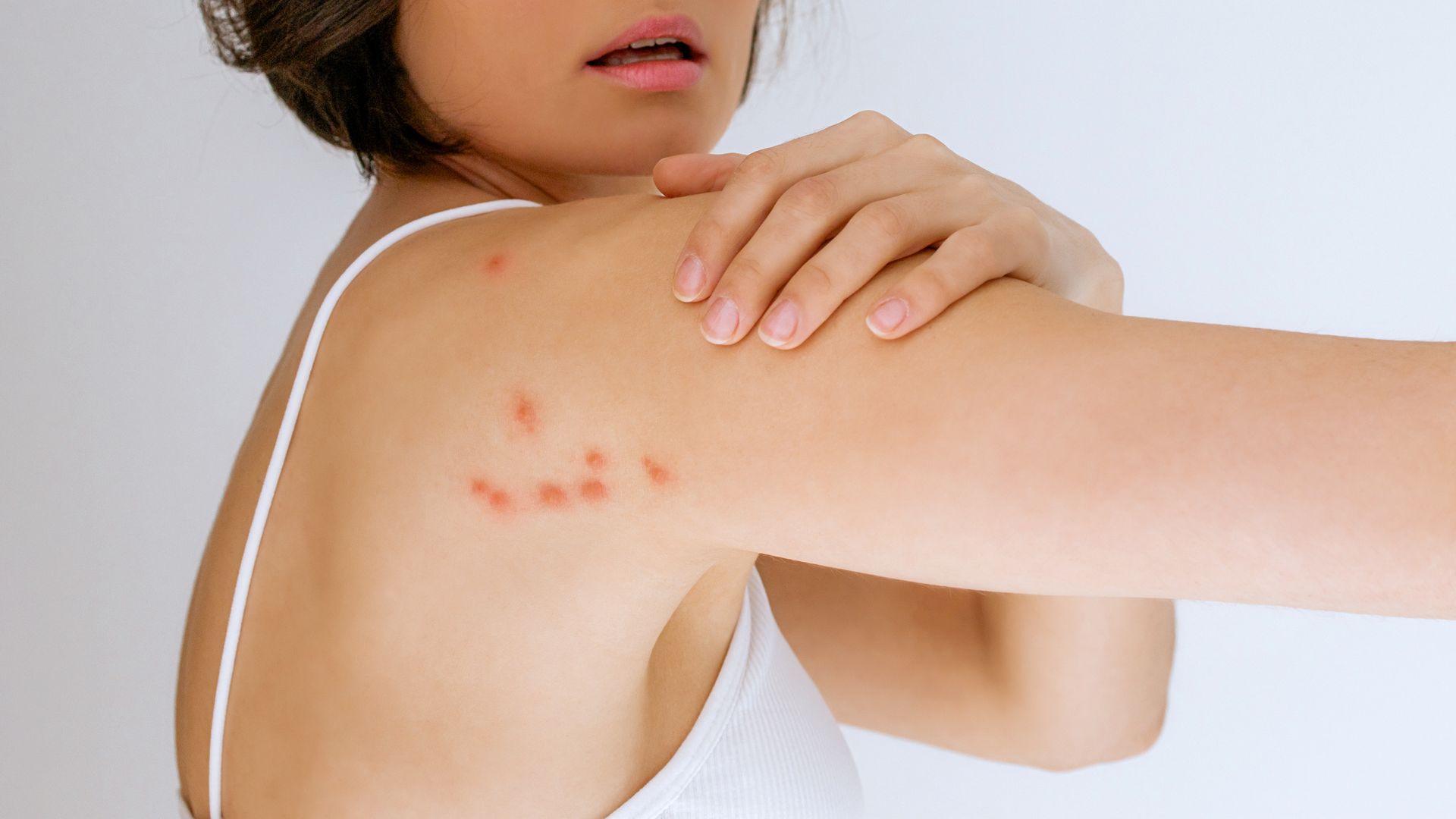 Herpes zoster: sintomi e contagio